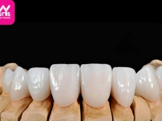 RĂNG SỨ EMAX ZIRCONIA