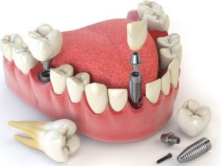 Phục Hình Implant