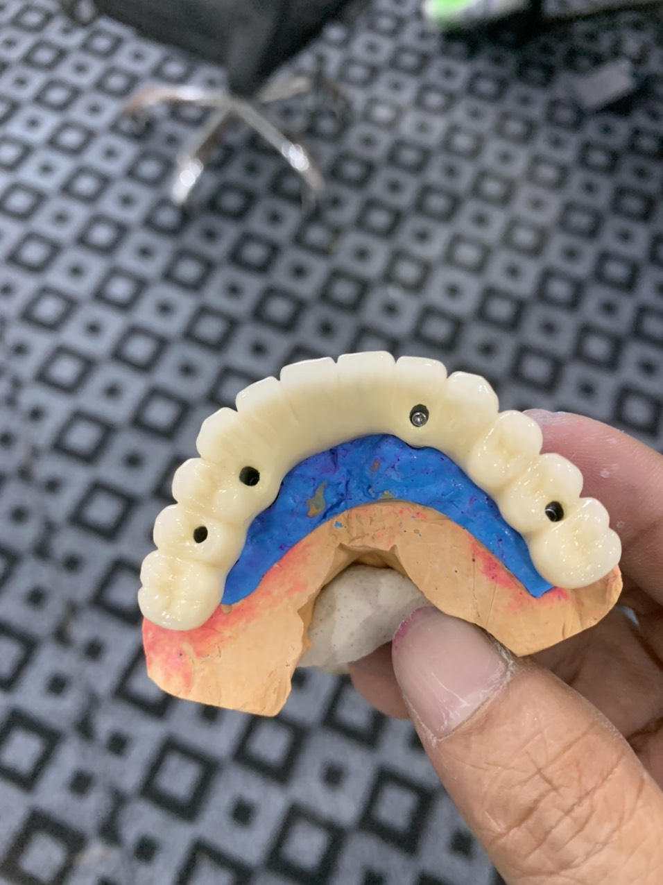 Phục hình răng sứ trên Implant